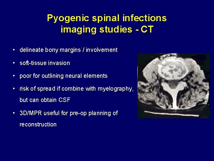 Pyogenic spinal infections imaging studies - CT • delineate bony margins / involvement •