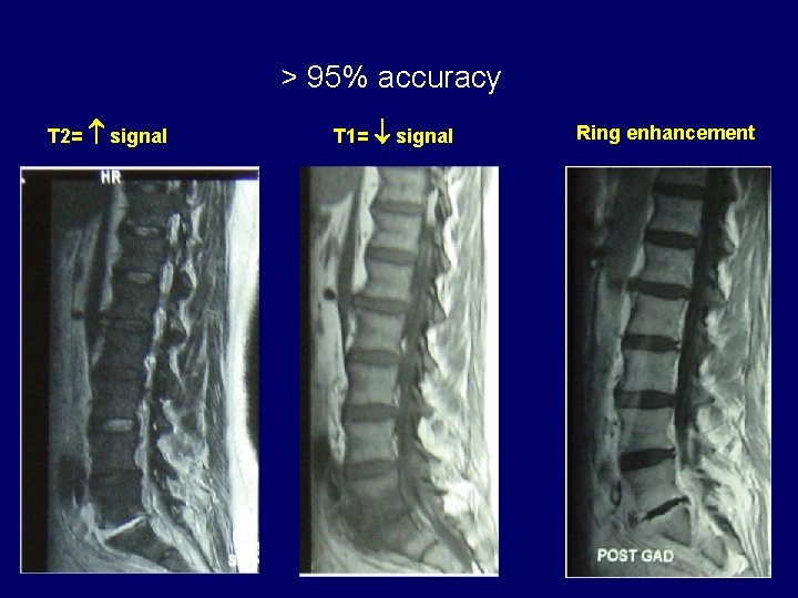 > 95% accuracy T 2= signal T 1= signal Ring enhancement 