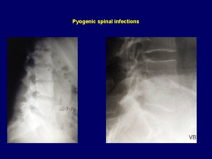Pyogenic spinal infections 