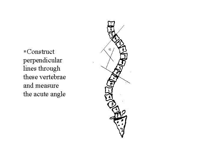 § Construct perpendicular lines through these vertebrae and measure the acute angle 