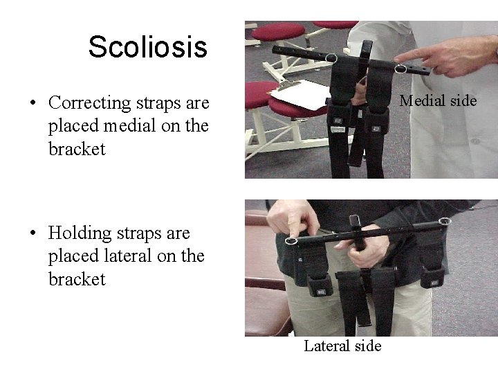 Scoliosis • Correcting straps are placed medial on the bracket Medial side • Holding