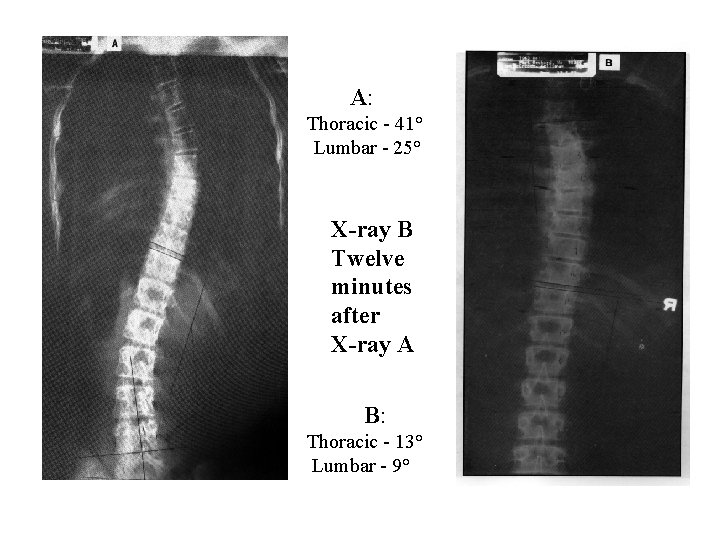 A: Thoracic - 41° Lumbar - 25° X-ray B Twelve minutes after X-ray A