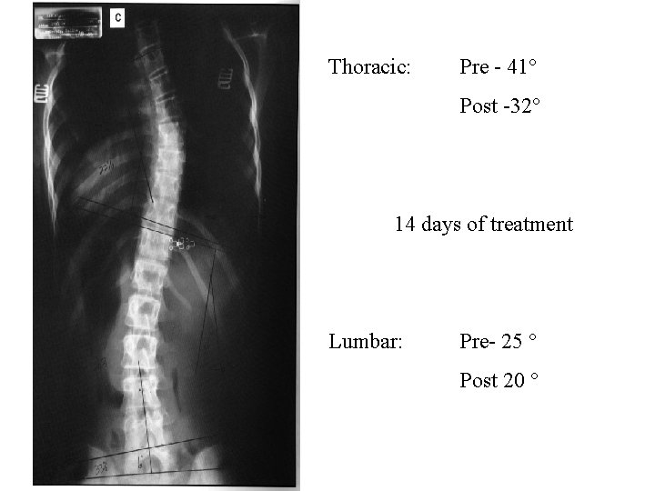 Thoracic: Pre - 41° Post -32° 14 days of treatment Lumbar: Pre- 25 °