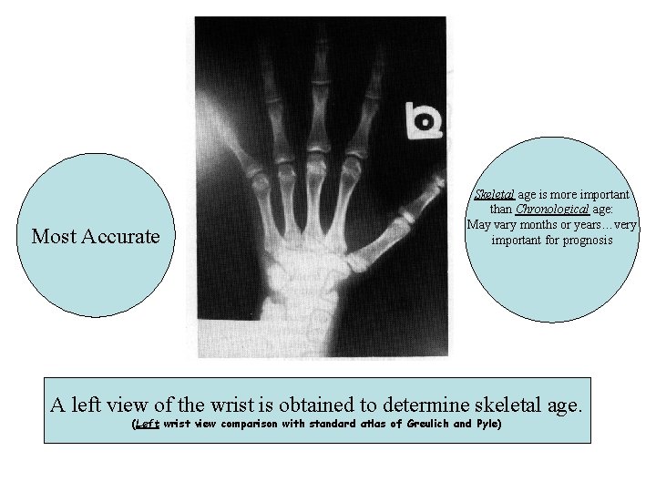 Most Accurate Skeletal age is more important than Chronological age: May vary months or