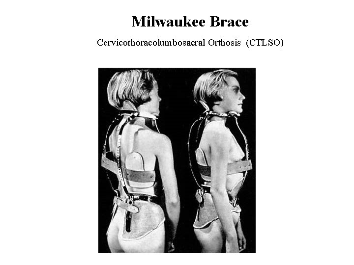 Milwaukee Brace Cervicothoracolumbosacral Orthosis (CTLSO) 