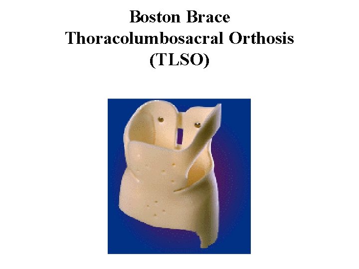 Boston Brace Thoracolumbosacral Orthosis (TLSO) 