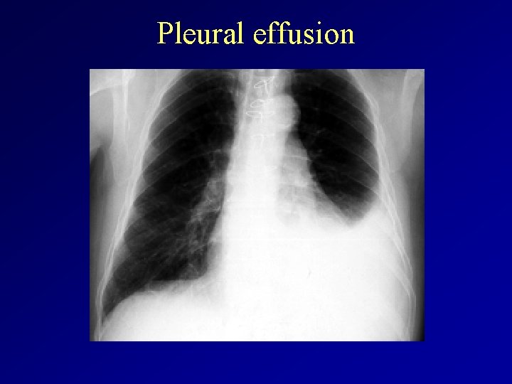 Pleural effusion 