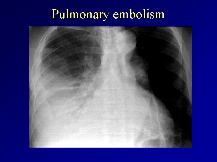 Pulmonary embolism 