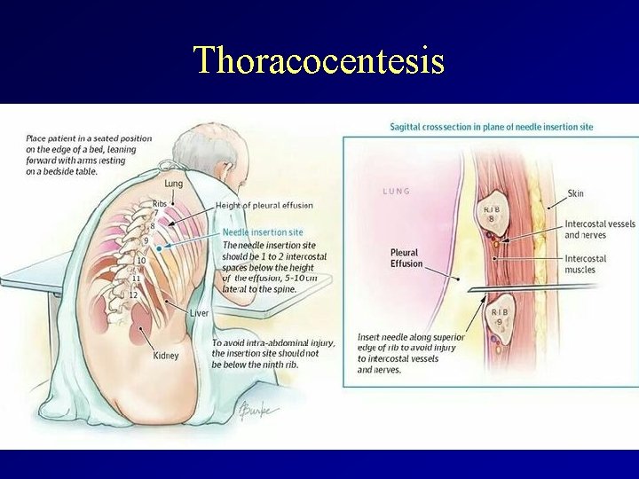 Thoracocentesis 