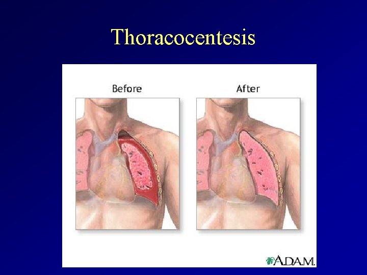 Thoracocentesis 