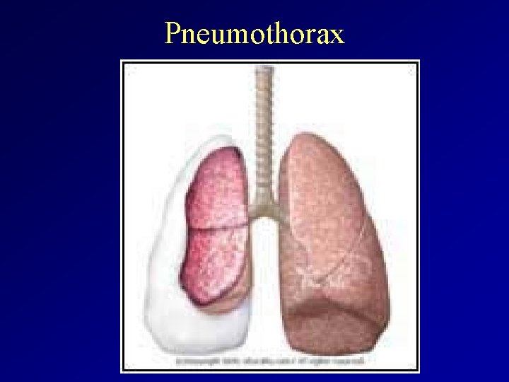 Pneumothorax 