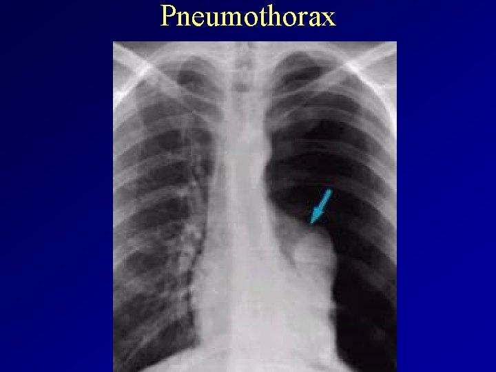 Pneumothorax 