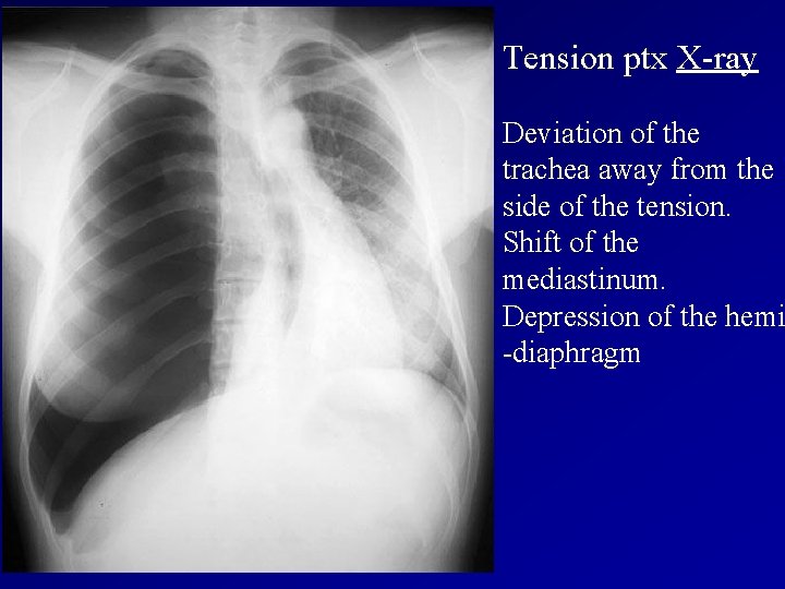 Tension ptx X-ray Deviation of the trachea away from the side of the tension.
