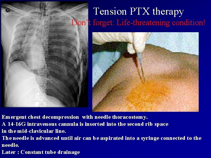 Tension PTX therapy Don’t forget: Life-threatening condition! Emergent chest decompression with needle thoracostomy. A