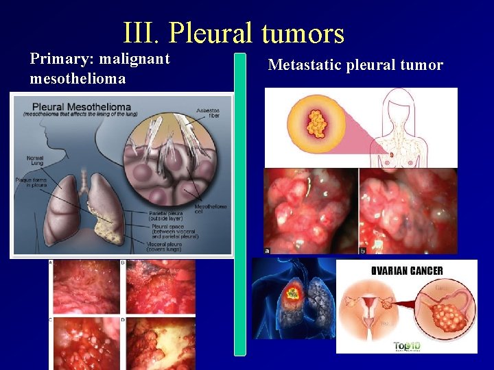 III. Pleural tumors Primary: malignant mesothelioma Metastatic pleural tumor 