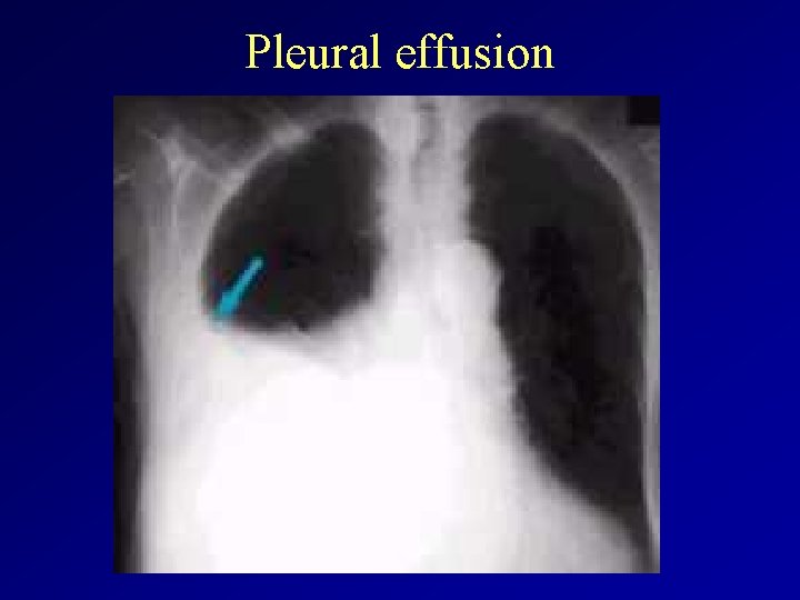 Pleural effusion 