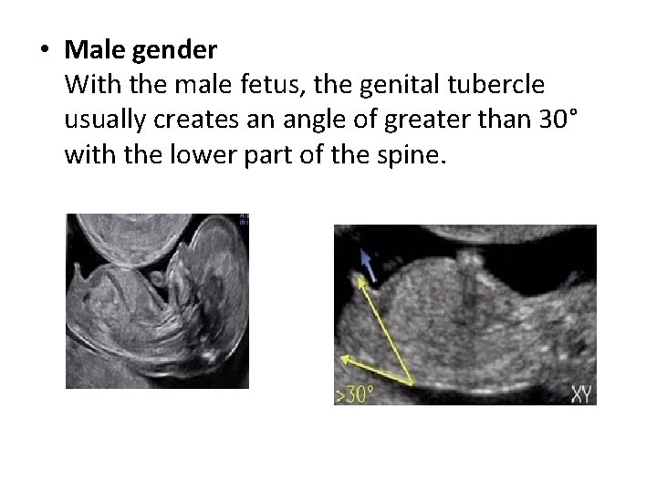  • Male gender With the male fetus, the genital tubercle usually creates an