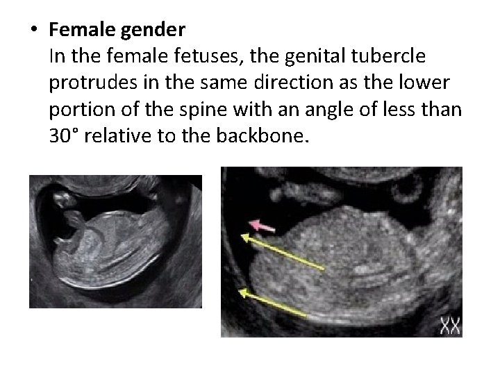  • Female gender In the female fetuses, the genital tubercle protrudes in the