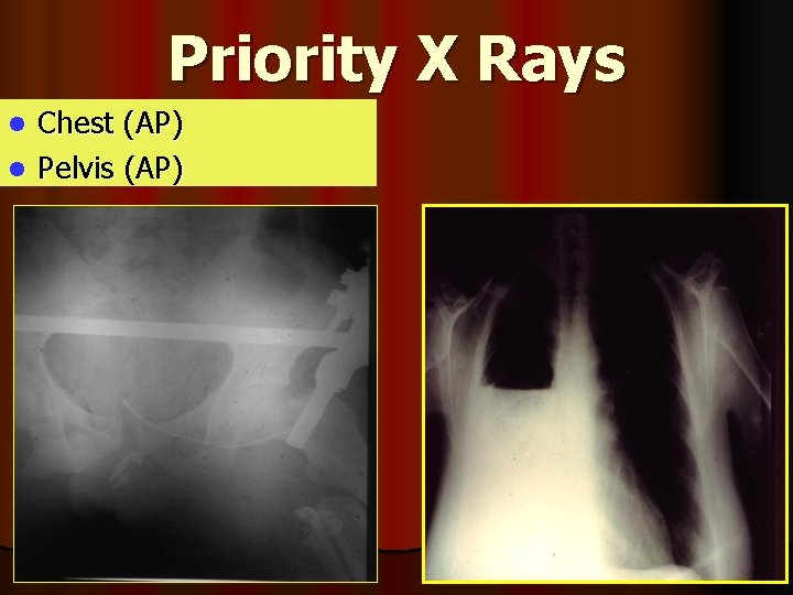 Priority X Rays Chest (AP) l Pelvis (AP) l 
