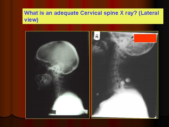 What is an adequate Cervical spine X ray? (Lateral view) 