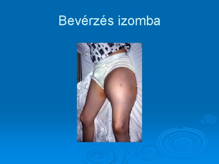 Bevérzés izomba 