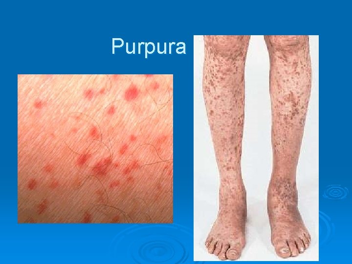 Purpura 