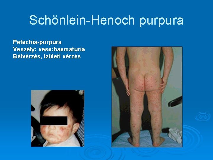 Schönlein-Henoch purpura Petechia-purpura Veszély: vese: haematuria Bélvérzés, ízületi vérzés 