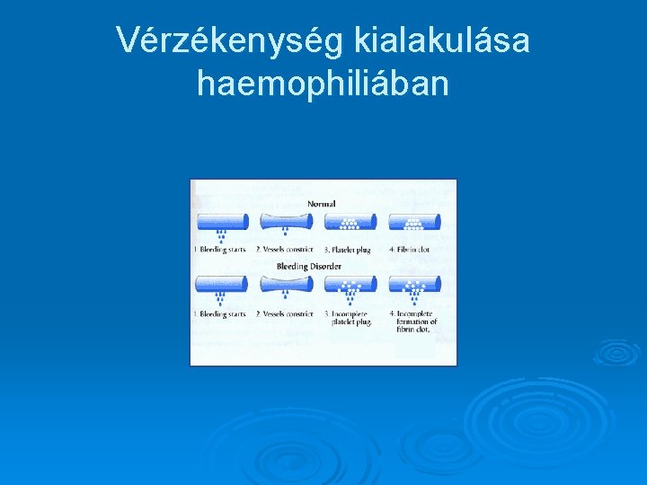 Vérzékenység kialakulása haemophiliában 