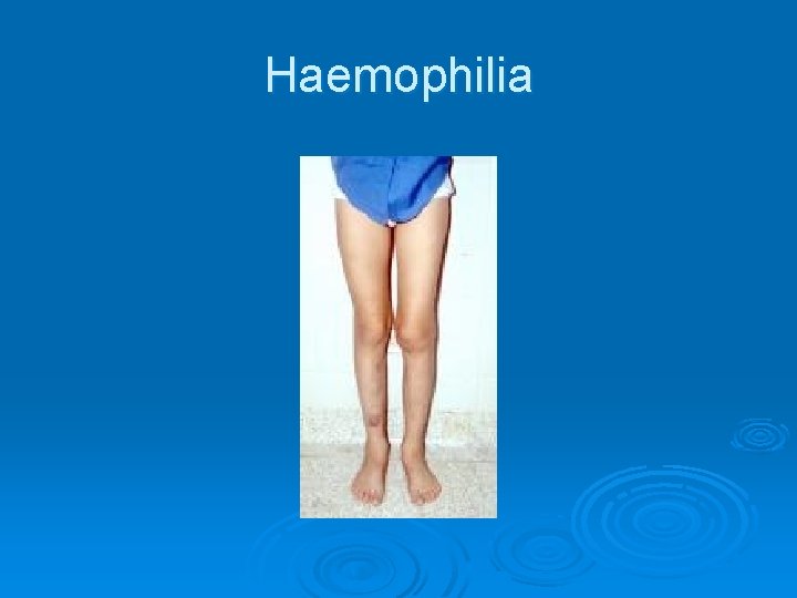 Haemophilia 