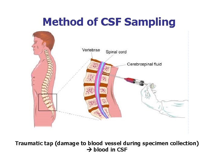 Method of CSF Sampling Traumatic tap (damage to blood vessel during specimen collection) blood