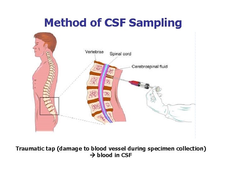 Method of CSF Sampling Traumatic tap (damage to blood vessel during specimen collection) blood Method of CSF Sampling Traumatic tap (damage to blood vessel during specimen collection) blood