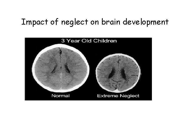 Impact of neglect on brain development 