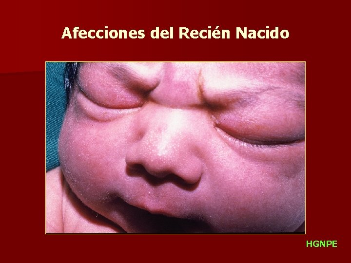 Afecciones del Recién Nacido HGNPE 