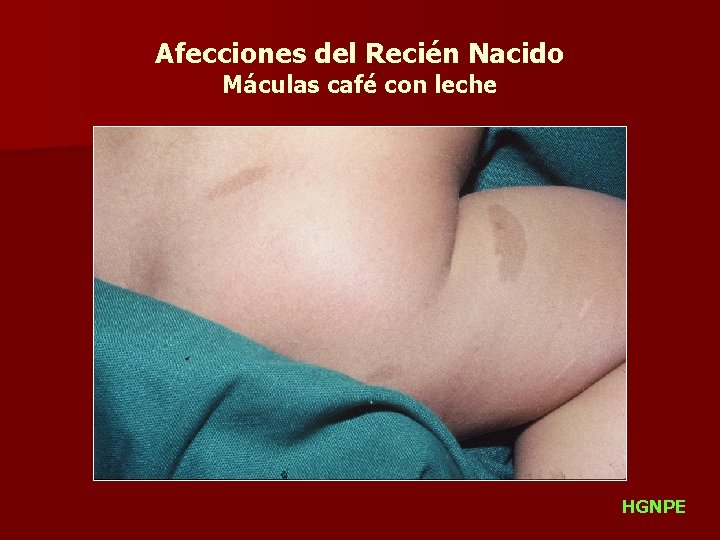 Afecciones del Recién Nacido Máculas café con leche HGNPE 