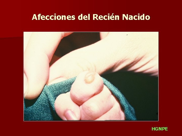 Afecciones del Recién Nacido HGNPE 