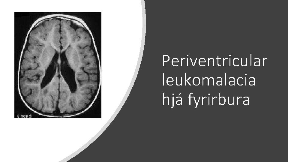 Periventricular leukomalacia hjá fyrirbura 