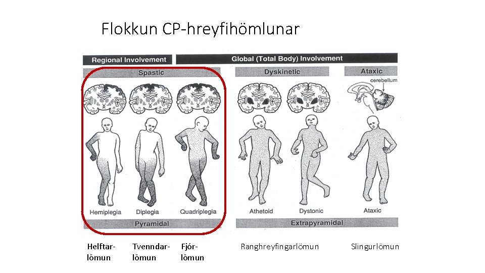 Flokkun CP-hreyfihömlunar Helftarlömun Tvenndarlömun Fjórlömun Ranghreyfingarlömun Slingurlömun 