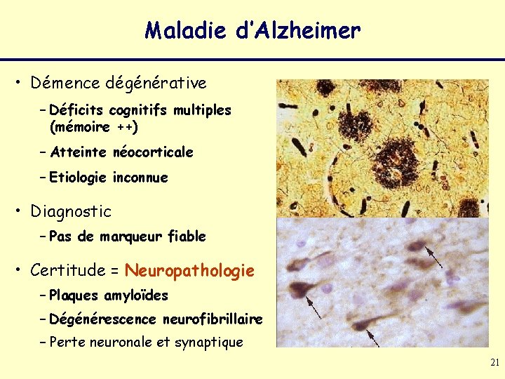 Maladie d’Alzheimer • Démence dégénérative – Déficits cognitifs multiples (mémoire ++) – Atteinte néocorticale