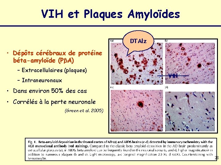 VIH et Plaques Amyloïdes DTAlz • Dépôts cérébraux de protéine béta-amyloïde (PβA) – Extracellulaires