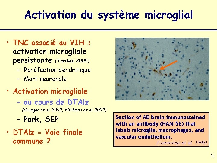 Activation du système microglial • TNC associé au VIH : activation microgliale persistante (Tardieu