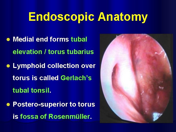 Endoscopic Anatomy l Medial end forms tubal elevation / torus tubarius l Lymphoid collection