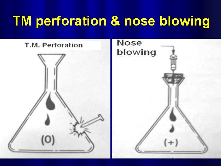 TM perforation & nose blowing 