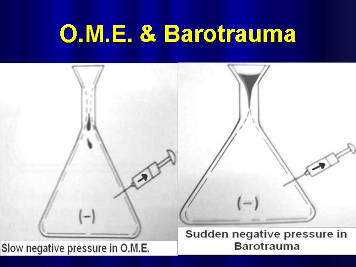O. M. E. & Barotrauma 