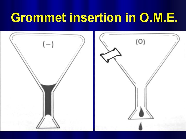 Grommet insertion in O. M. E. 