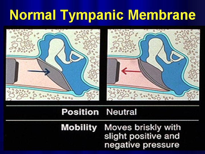 Normal Tympanic Membrane 