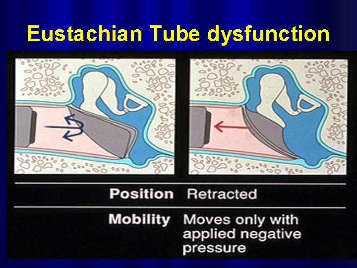 Eustachian Tube dysfunction 