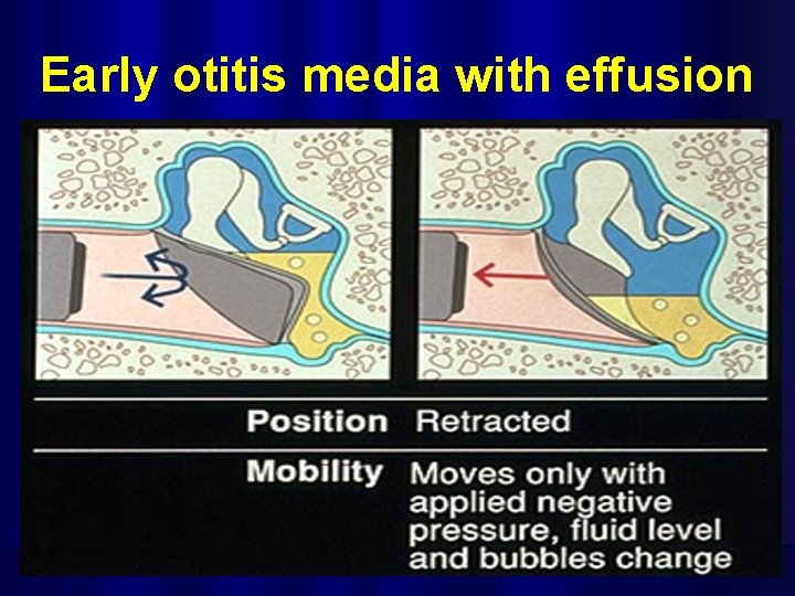 Early otitis media with effusion 
