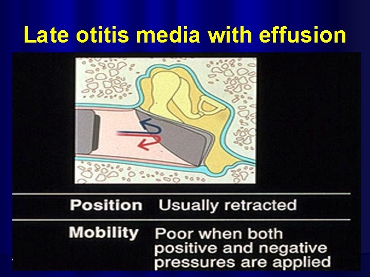 Late otitis media with effusion 