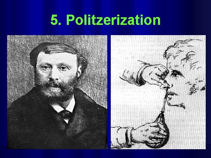 5. Politzerization 