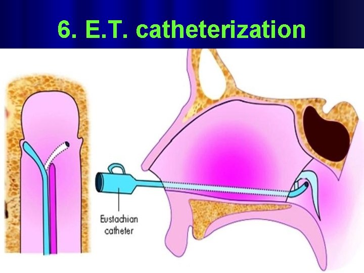 6. E. T. catheterization 